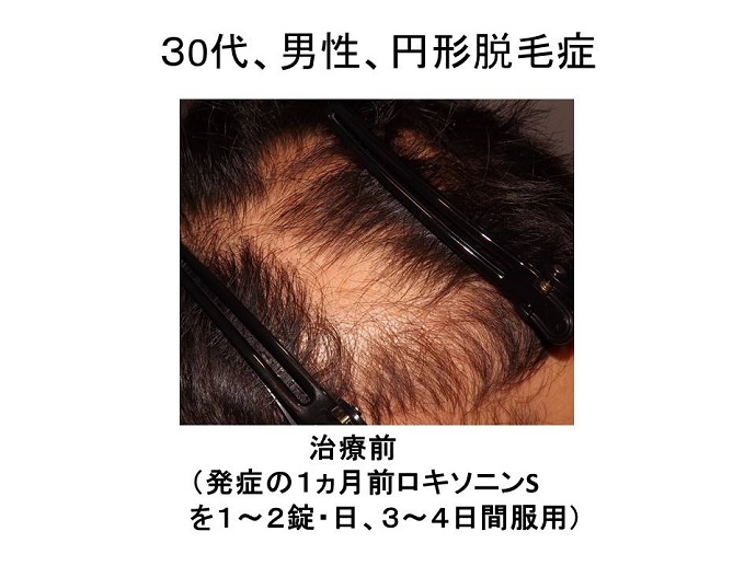 円形脱毛症　病院""